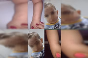 Marcas de mordidas na cabeça e no braço do bebê