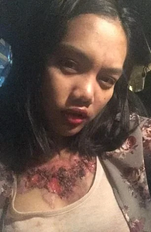 Garota relata momentos de dor ao remover tatuagem com método polêmico - imagem 8 Garota relata momentos de dor ao remover tatuagem com método polêmico - imagem 8