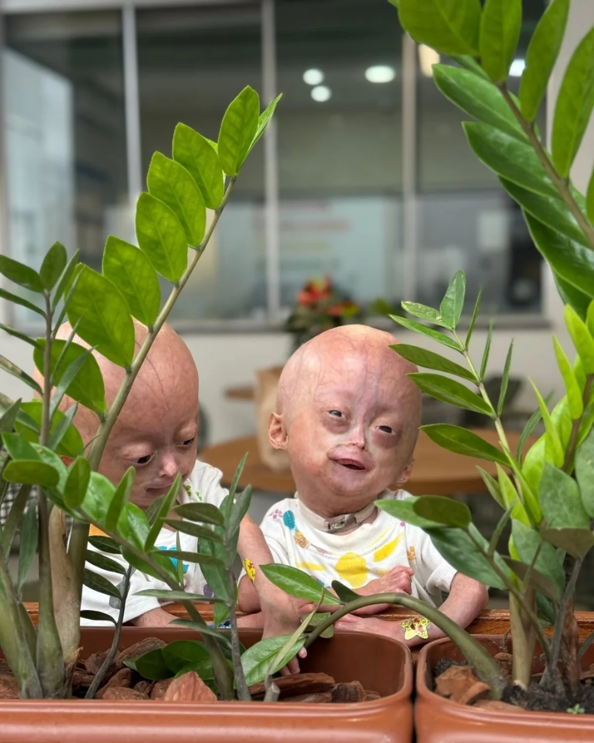Elis Carneiro Lima, e a irmã gêmea, Eloá, meninas de 5 anos diagnosticada com síndrome rara Elis Carneiro Lima, e a irmã gêmea, Eloá, meninas de 5 anos diagnosticada com síndrome rara