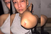 Lesões no corpo da vítima