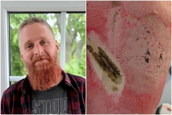 Homem sofre queimadura após bateria de vape explodir
