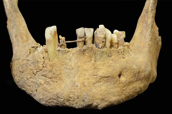 Imagem colorida de mandíbula com ponte dentária de 500 anos - Metrópoles