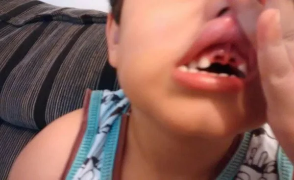 Mãe denuncia escola após filho de 4 anos perder dois dentes