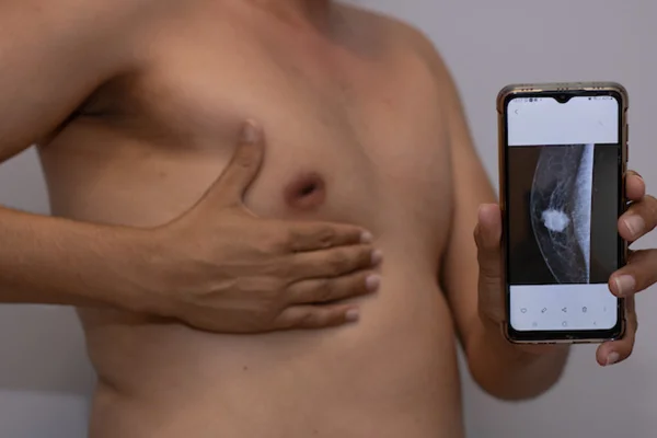 André de Melo, homem diagnosticado com câncer de mama