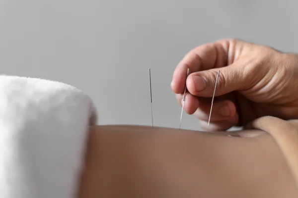 Imagem mostra agulhas de acupuntura nas costas de uma pessoa - Metrópoles