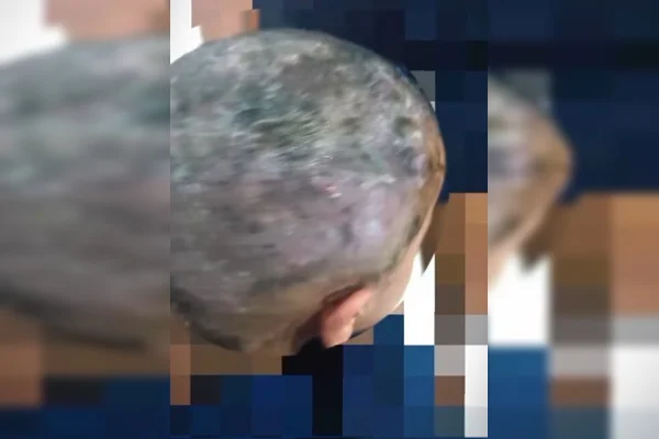 Criança que estava com bichos na cabeça