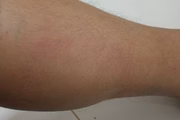 Hematomas na perna