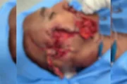 Catador mutilado por pit-bulls passa por reconstrução de face no Rio - imagem 3 Catador mutilado por pit-bulls passa por reconstrução de face no Rio - imagem 3