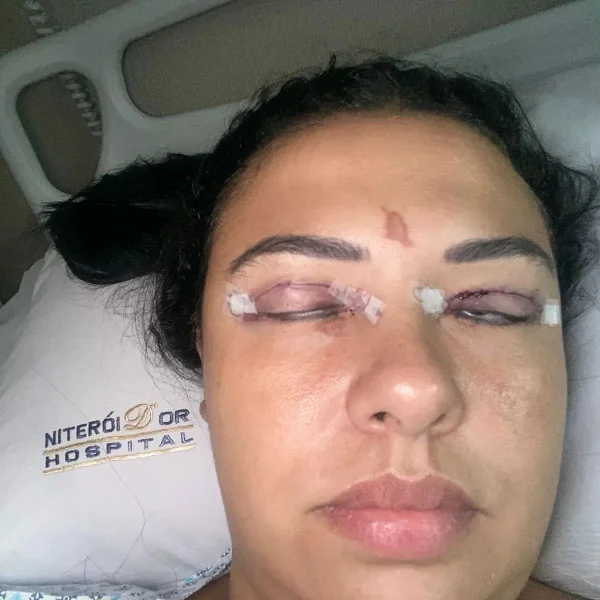 Mulher tem cílios colados Super Bonder