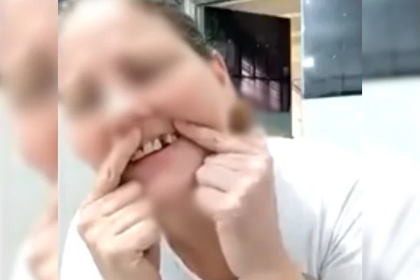 Foto colorida e borrada de suspeita mostrando o dente quebrado após agressões em presídio - Metrópoles