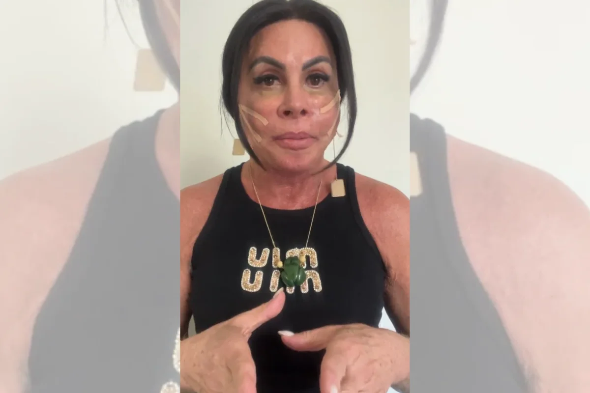 Gretchen com os fios de sustentação no rosto Gretchen com os fios de sustentação no rosto