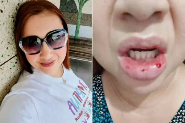 Imagem colorida mostra mulher com a boca inchada após usar pasta de dente - Metrópoles