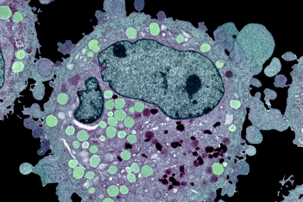 Imagem de microscópio colorida de uma célula de carcinoma, que é um tipo de câncer de pele - Metrópoles