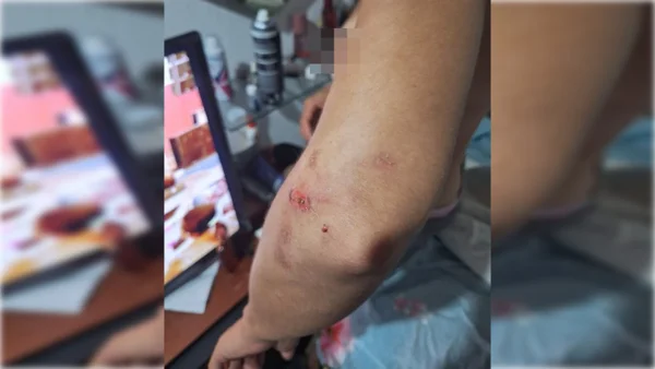 Imagem mostra ferimentos de mulher trans espancada por três homens em Maceió - Metrópoles