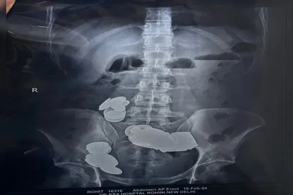 Imagem mostra o exame de raio x de um homem com várias obstruções em seu intestino