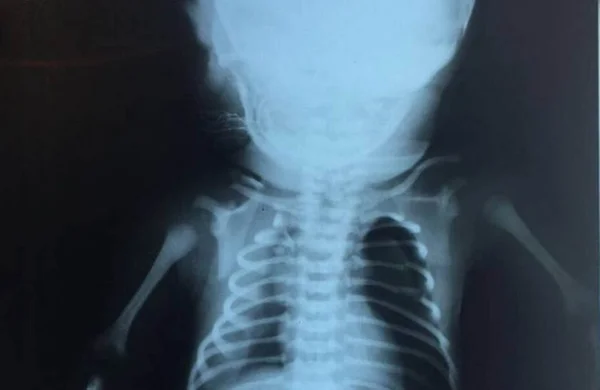 Bebê baleado dentro da barriga da mãe está com coágulo na cabeça