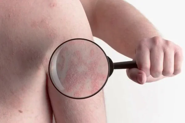 Risco de apresentar herpes-zóster aumenta 15% após Covid, diz pesquisa