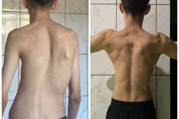 Imagem colorida de jovem magro com escoliose na esquerda e jovem forte na direita - Metrópoles