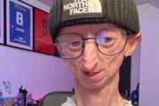 Michiel Vandeweert compartilhava sua rotina com a doença rara nas redes sociais