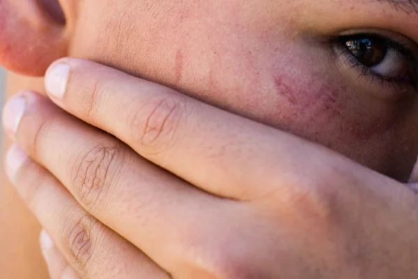 Adolescente espancado por homem no Núcleo Bandeirante mostra hematomas