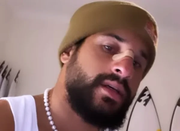 ítalo Ferreira de nariz quebrado