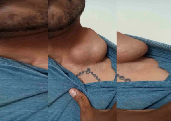 Homem espera cirurgia para retirar tumor