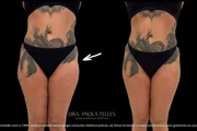Antes e depois do bumbum da miss São Paulo, Valentina Miranda Antes e depois do bumbum da miss São Paulo, Valentina Miranda