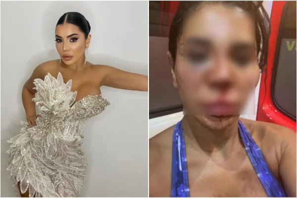 Imagem colorida, Influenciadora sofre tortura e tem rosto desfigurado durante assalto - Metrópoles
