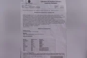 Exame de DNA feito no Hospital Albert Einstein que aponta origem do adenocarcinoma no fígado transplantado em Geraldo
