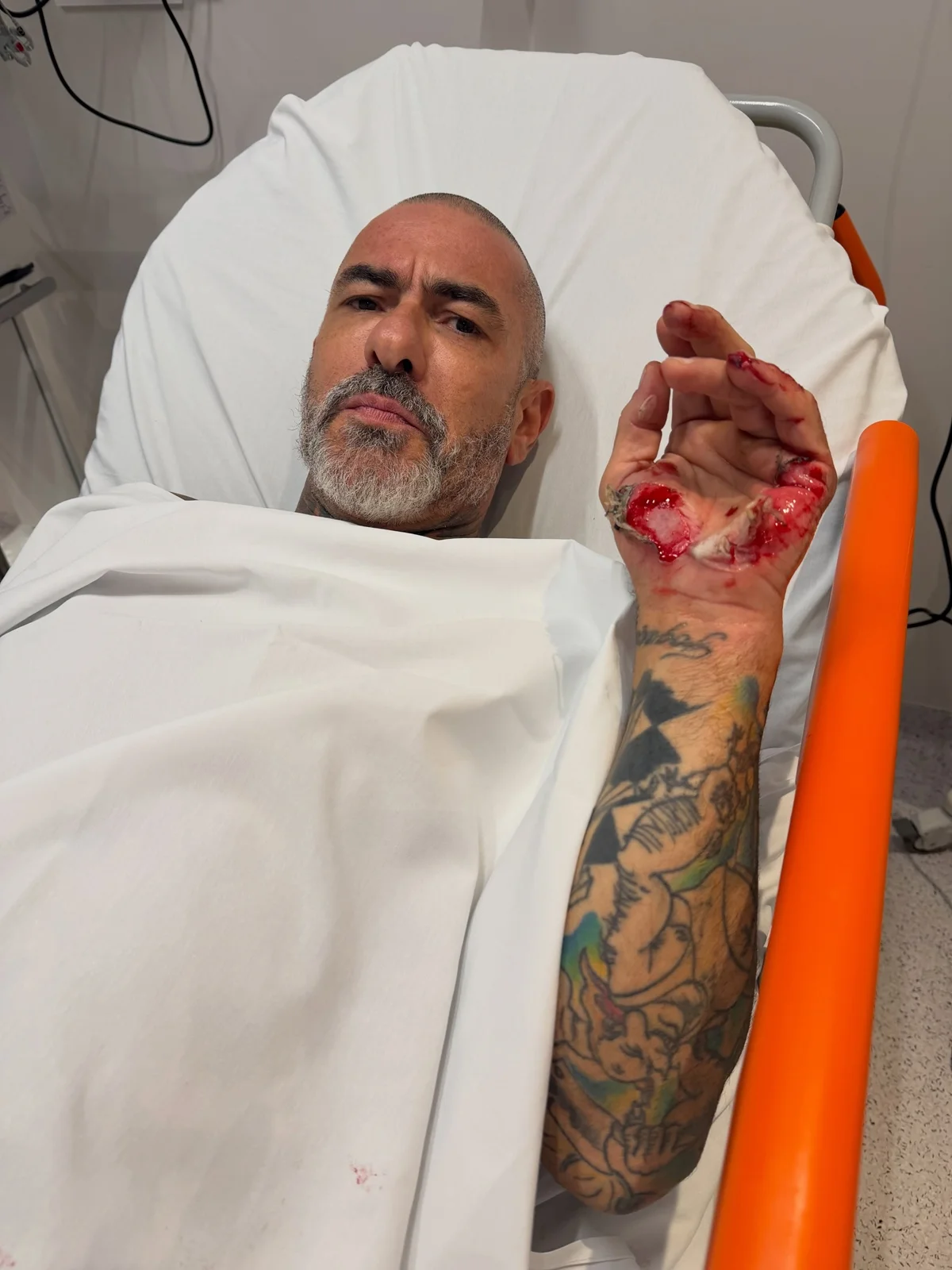 Chef Henrique Fogaça mostra lesões de acidente de moto que o afastou do MasterChef Chef Henrique Fogaça mostra lesões de acidente de moto que o afastou do MasterChef