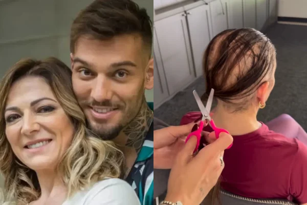 Alopecia: tricologista explica condição vivida pela mãe de Lucas Lucco