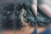 Couro cabeludo da criança com larvas Couro cabeludo da criança com larvas