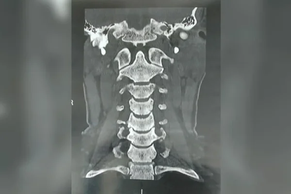 Veja detalhes das tomografias feitas por Joice após suposto atentado
