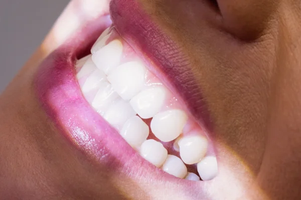 Foto colorida com zoom em boca feminina, que mostra os dentes e gengivas - Metrópoles