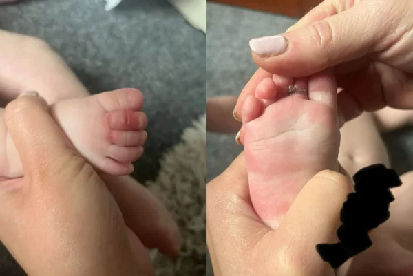Bebê fica com cabelos presos nos dedos dos pés. Mãe alerta sobre cuidado com lavagem de roupa. Metrópoles