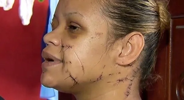 Inquilina leva 100 pontos no rosto após facadas de dono da casa