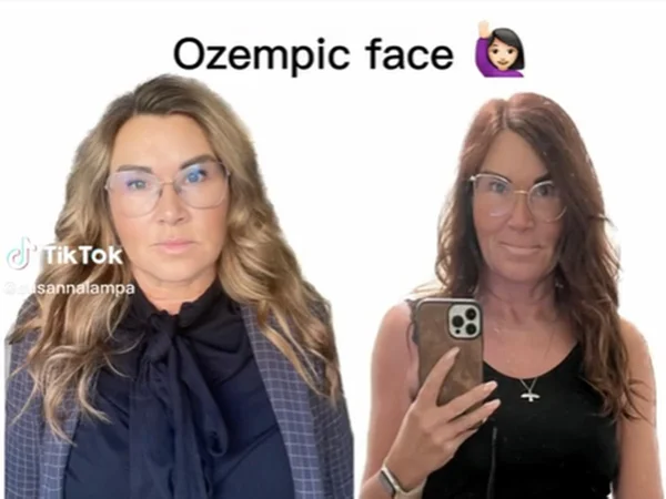 Imagem colorida de mulher mostrando os efeitos do ozempic no rosto - Metrópoles