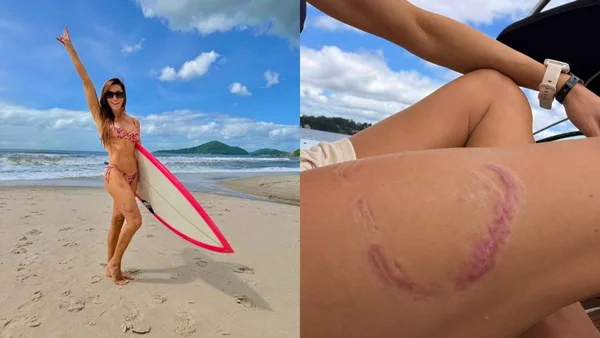 Fotos coloridas de Tayane na praia e da cicatriz pela mordida de tubarão