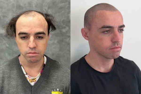 Foto colorida de um homem no antes e depois - Metrópoles