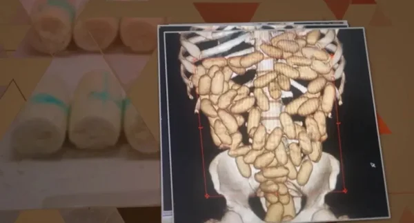 imagens de cápsulas de drogas em raio x - metrópoles