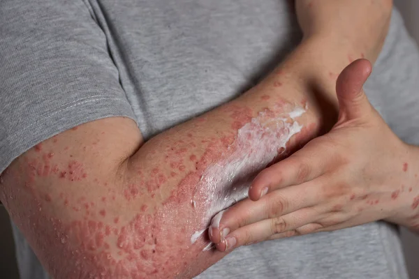 Foto colorida de braço humano com manchas vermelhas, dermatite - Metrópoles