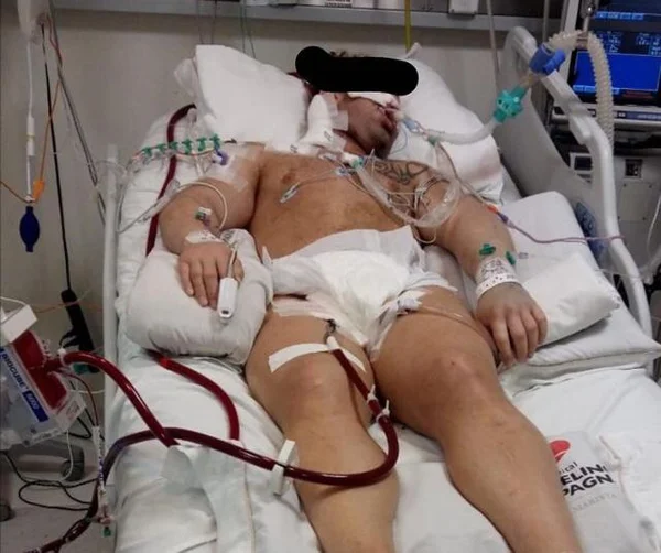 Faltam insumos para a Ecmo, máquina que salva pacientes de Covid