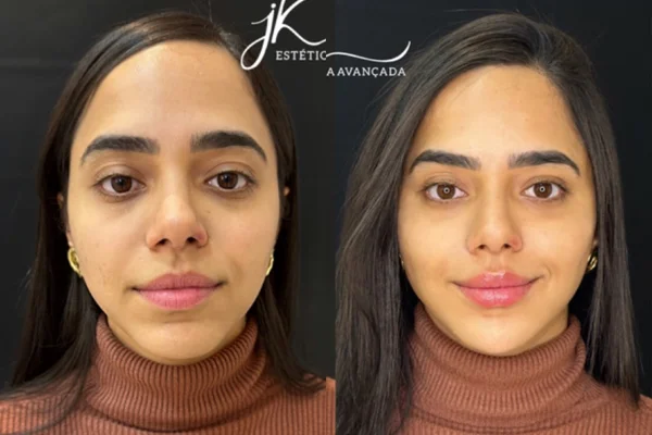 Mariely faz harmonização facial. Veja fotos e saiba valor