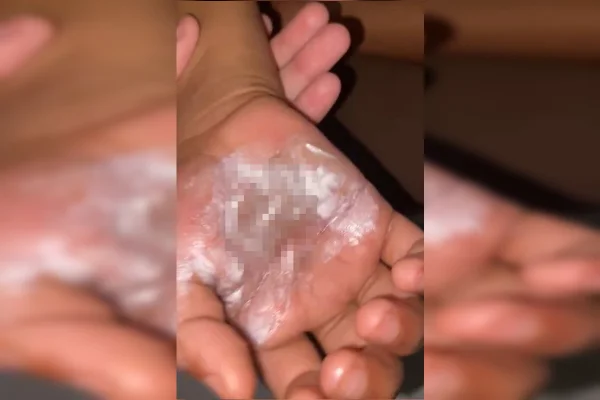 Mãe aquece colher no fogão e queima mãos do filho de propósito no Entorno - destaque galeria