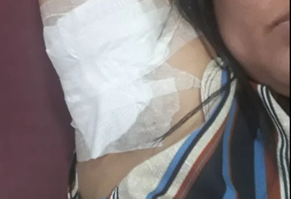 Alerta: brasiliense tem queimadura grave com técnica de depilação