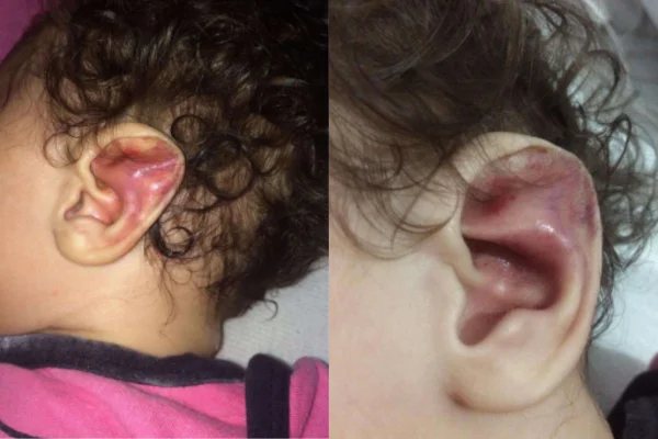 Imagem colorida de montagem com bebê com lesões na orelha. Metrópoles