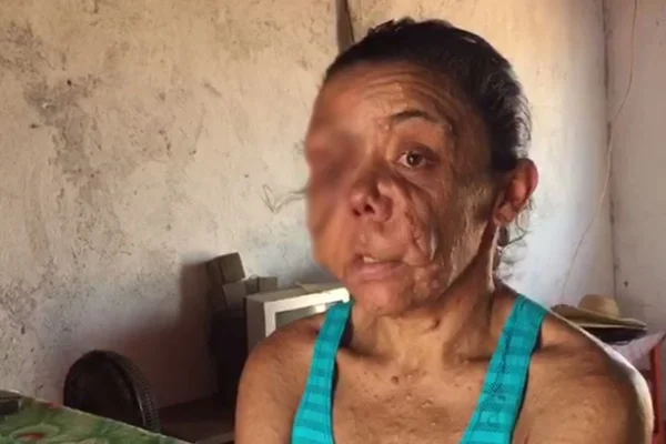Mulher com rosto deformado diz: “Meu pior inimigo é o espelho”