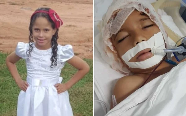 Menina tem orelhas e couro cabeludo arrancados por trator