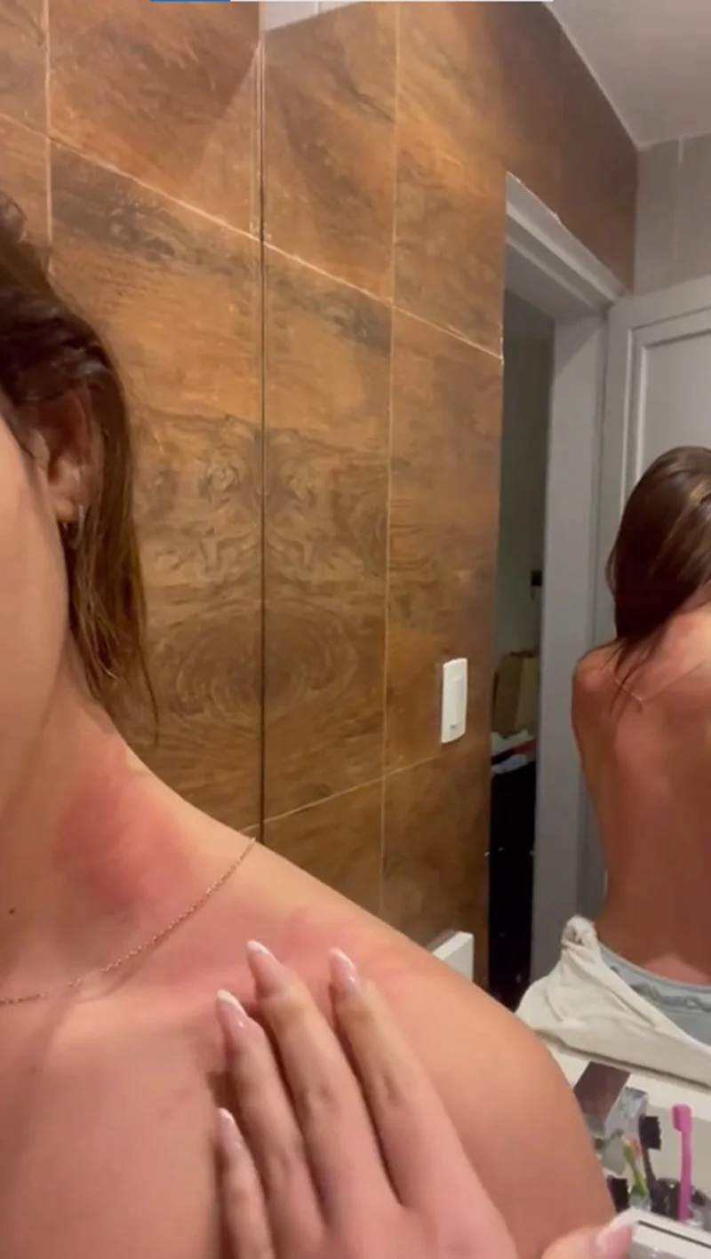 Larissa mostra o seu pescoço inchado Larissa mostra o seu pescoço inchado