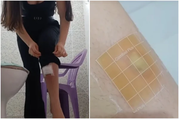 Influenciadora quase fica sem andar após arrancar pelo encravado
